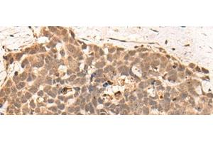 Immunohistochemistry of paraffin-embedded Human thyroid cancer tissue using CLK2 Polyclonal Antibody at dilution of 1:45(x200)