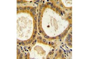 Formalin fixed and paraffin embedded human prostate carcinoma reacted with CD152 / CTLA4 Antibody (N-term) followed by peroxidase conjugation of the secondary antibody and DAB staining. (CTLA4 抗体  (N-Term))