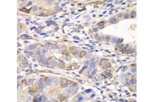 Immunohistochemistry of paraffin-embedded Human gastric cancer using GCLM Polyclonal Antibody at dilution of 1:100 (40x lens). (GCLM 抗体)