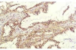 Immunohistochemistry of paraffin-embedded Human lung carcinoma tissue using IL8 Monoclonal Antibody at dilution of 1:200. (IL-8 抗体)