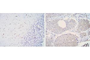 Immunohistochemical analysis of paraffin-embedded cerebellum tissues (left) and lung cancer (right) using ALDH1A1 mouse mAb with DAB staining. (ALDH1A1 抗体)