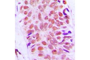 Immunohistochemical analysis of RPS8 staining in human breast cancer formalin fixed paraffin embedded tissue section. (RPS8 抗体  (Center))