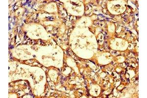 Immunohistochemistry of paraffin-embedded human gastric cancer using ABIN7171428 at dilution of 1:100 (CCT8 抗体  (AA 224-491))