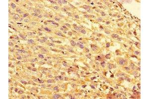 Immunohistochemistry of paraffin-embedded human melanoma using ABIN7152193 at dilution of 1:100