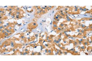 Immunohistochemistry of paraffin-embedded Human thyroid cancer tissue using CXCL14 Polyclonal Antibody at dilution 1:40 (CXCL14 抗体)