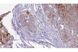 ABIN6277846 at 1/100 staining Human urothelial cancer tissue by IHC-P. (INSRR 抗体  (N-Term))
