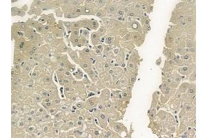 ABIN6263420 and ABIN6273269 at 1/100 staining human hepatocellular carcinoma by IHC-P. (MTHFD1L 抗体  (C-Term))