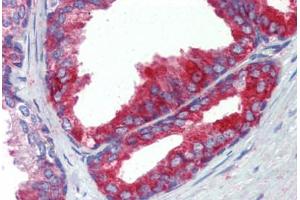 Human Prostate (formalin-fixed, paraffin-embedded) stained with FASN antibody ABIN462322 followed by biotinylated goat anti-rabbit IgG secondary antibody ABIN481713, alkaline phosphatase-streptavidin and chromogen. (Fatty Acid Synthase 抗体  (AA 942-973))