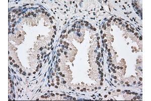 Immunohistochemical staining of paraffin-embedded Adenocarcinoma of Human ovary tissue using anti-BAT1 mouse monoclonal antibody. (BAT1 抗体)