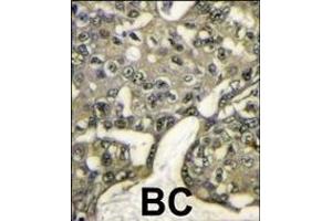 Formalin-fixed and paraffin-embedded human breast carcinoma reacted with AKT1 antibody (N-term) (ABIN391212 and ABIN2841290) , which was peroxidase-conjugated to the secondary antibody, followed by DAB staining.