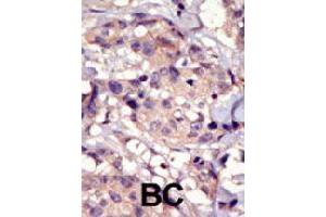 Formalin-fixed and paraffin-embedded human cancer tissue reacted with PDGFRA polyclonal antibody  , which was peroxidase-conjugated to the secondary antibody, followed by DAB staining. (PDGFRA 抗体  (C-Term))