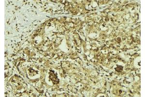 ABIN6267214 at 1/100 staining Human breast cancer tissue by IHC-P. (CDK6 抗体  (pTyr292))