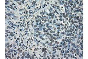 Immunohistochemical staining of paraffin-embedded Carcinoma of kidney tissue using anti-NEK6mouse monoclonal antibody. (NEK6 抗体)
