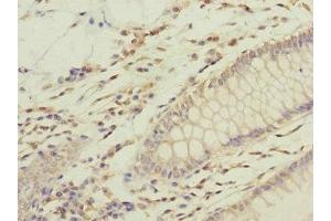 Immunohistochemistry of paraffin-embedded human colon cancer using ABIN7168218 at dilution of 1:100 (GFM2 抗体  (AA 520-779))