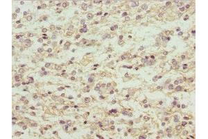 Immunohistochemistry of paraffin-embedded human glioma using ABIN7159294 at dilution of 1:100 (MAGED1 抗体  (AA 579-778))