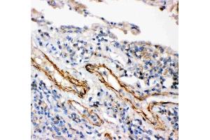 Anti-IKK beta antibody, (ABIN3042734),IHC(P) IHC(P): Human Lung Cancer Tissue