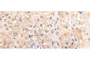 Immunohistochemistry of paraffin-embedded Human liver cancer tissue using ITGA3 Polyclonal Antibody at dilution of 1:45(x200) (ITGA3 抗体)
