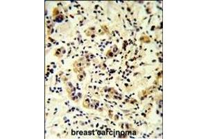 CC50B Antibody (N-term) (ABIN651159 and ABIN2840104) IHC analysis in formalin fixed and paraffin embedded human breast carcinoma followed by peroxidase conjugation of the secondary antibody and DAB staining. (TMEM30B 抗体  (N-Term))