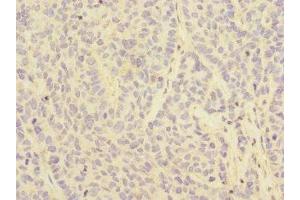 Immunohistochemistry of paraffin-embedded human ovarian cancer using ABIN7158546 at dilution of 1:100 (FCGR2C 抗体  (AA 43-223))