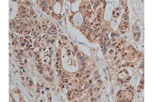 ABIN6255221 and ABIN6267478 at 1/50 staining human colon cancer tissue sections by IHC-P. (beta Catenin 抗体  (pSer33))
