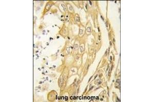 Formalin-fixed and paraffin-embedded human lung carcinoma tissue reacted with the EphB4 antibody (ABIN391924 and ABIN2841734) , which was peroxidase-conjugated to the secondary antibody, followed by DAB staining. (EPH Receptor B4 抗体)