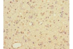 Immunohistochemistry of paraffin-embedded human glioma using ABIN7158053 at dilution of 1:100 (LINGO1 抗体  (AA 42-240))