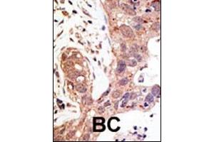 Formalin-fixed and paraffin-embedded human cancer tissue reacted with the primary antibody, which was peroxidase-conjugated to the secondary antibody, followed by AEC staining. (SENP1 抗体  (N-Term))