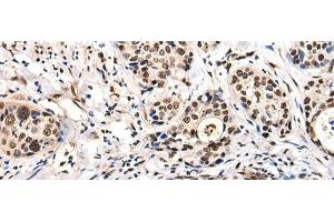 Immunohistochemistry of paraffin-embedded Human cervical cancer tissue using USP6NL Polyclonal Antibody at dilution of 1:30(x200) (USP6NL 抗体)