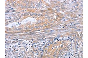 The image on the left is immunohistochemistry of paraffin-embedded Human cervical cancer tissue using ABIN7189998(BOD1 Antibody) at dilution 1/30, on the right is treated with synthetic peptide. (BOD1 抗体)