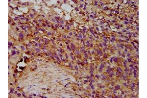 IHC image of ABIN7151818 diluted at 1:300 and staining in paraffin-embedded human ovarian cancer performed on a Leica BondTM system. (EPX 抗体  (AA 140-300))