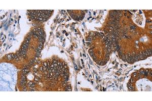 Immunohistochemistry of paraffin-embedded Human colon cancer tissue using IHH Polyclonal Antibody at dilution 1:30 (Indian Hedgehog 抗体)