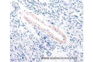 Immunohistochemistry of Human gastric cancer using TPM1 Polyclonal Antibody at dilution of 1:80 (Tropomyosin 抗体)