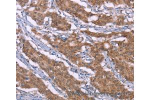 Immunohistochemistry of Human liver cancer using HRH3 Polyclonal Antibody at dilution of 1:40 (HRH3 抗体)