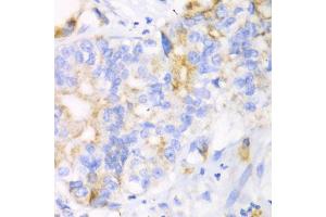 Immunohistochemistry of paraffin-embedded human liver cancer using CHIA antibody (ABIN6292576) at dilution of 1:100 (40x lens). (CHIA 抗体)