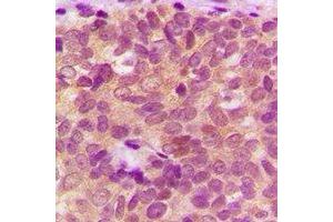 Immunohistochemical analysis of IDE staining in human breast cancer formalin fixed paraffin embedded tissue section. (IDE 抗体)