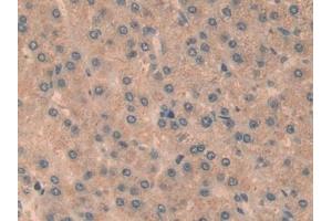 Detection of RELB in Human Liver cancer Tissue using Polyclonal Antibody to V-Rel Reticuloendotheliosis Viral Oncogene Homolog B (RELB) (RELB 抗体  (AA 248-492))