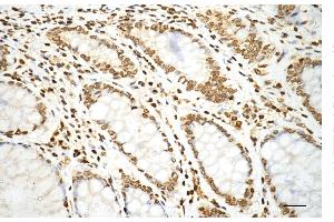 Immunohistochemistry was performed on paraffin-embedded human sigmoid colon carcinoma using histone H3 (mono methyl K79) antibody (ABIN7798961), 1:200). (Recombinant Histone 3 抗体  (H3K79me1))