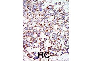 Formalin-fixed and paraffin-embedded human hepatocellular carcinoma tissue reacted with the MAP3K7 polyclonal antibody , which was peroxidase-conjugated to the secondary antibody, followed by AEC staining. (MAP3K7 抗体  (C-Term))