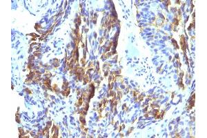 Formalin-fixed, paraffin-embedded human Tongue stained with Melanoma Monoclonal Antibody (KBA. (Melanoma Associated Antigen (KBA.62) 抗体)
