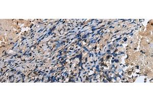 Immunohistochemistry of paraffin-embedded Human lung cancer tissue using ABHD14B Polyclonal Antibody at dilution of 1:30(x200) (ABHD14B 抗体)