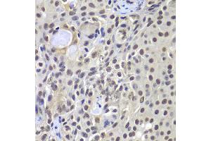 Immunohistochemistry of paraffin-embedded human well-differentiated squamous skin carcinoma using PRKDC antibody at dilution of 1:100 (x400 lens). (PRKDC 抗体)