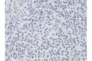 Immunohistochemistry of paraffin-embedded human adenomyosis using LMNB2 Antibody (ABIN5973877) at dilution of 1/100 (40x lens). (Lamin B2 抗体)