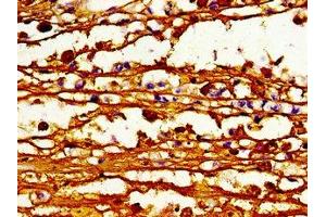 Immunohistochemistry of paraffin-embedded human melanoma using ABIN7163123 at dilution of 1:100 (ABCB4 抗体  (AA 530-693))