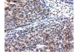 Immunohistochemical staining of paraffin-embedded Carcinoma of Human kidney tissue using anti-QPRT mouse monoclonal antibody. (QPRT 抗体)
