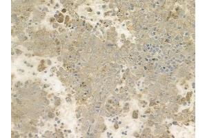 ABIN6257016 and ABIN6274443 at 1/100 staining human melanoma by IHC-P. (EPS8-Like 1 抗体  (Internal Region))