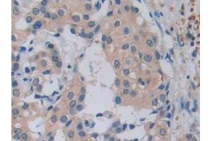 Detection of GHRH in Human Breast cancer Tissue using Monoclonal Antibody to Growth Hormone Releasing Hormone (GHRH) (GHRH 抗体  (AA 19-108))