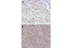 Immunohistochemical analysis of paraffin-embedded human lung cancer (A) and esophagus cancer (B), showing nuclear weak staining with DAB staining using MLL monoclonal antibody, clone 10F8D7 . (MLL/KMT2A 抗体)