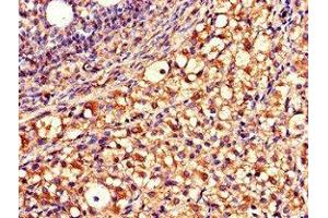 Immunohistochemistry of paraffin-embedded human ovarian cancer using ABIN7149920 at dilution of 1:100 (QDPR 抗体  (AA 2-244))