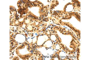 Immunohistochemistry of Human thyroid cancer using SERPINB1 Polyclonal Antibody at dilution of 1:30 (SERPINB1 抗体)