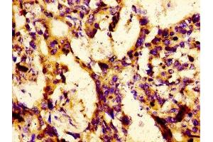 Immunohistochemistry of paraffin-embedded human gastric cancer using ABIN7158434 at dilution of 1:100 (LBP 抗体  (AA 304-414))
